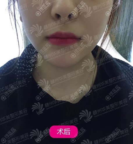 赣州华美面部吸脂案例1月效果 赣州华美面部吸脂案例1月效果