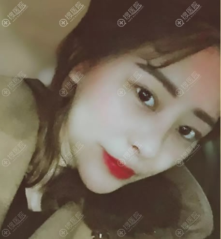 赣州华美牛先翠面部吸脂案例 赣州华美牛先翠面部吸脂案例