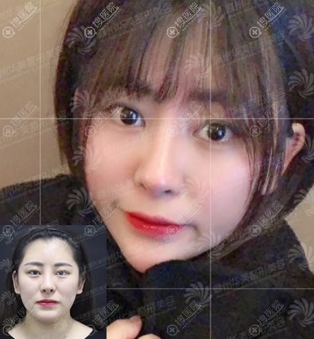 赣州华美面部吸脂案例对比图 赣州华美面部吸脂案例对比图
