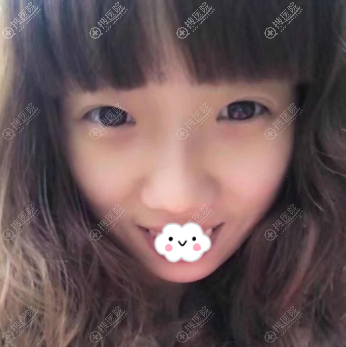 成都恒博王强双眼皮+硅胶假体隆鼻案例术后恢复效果图在这里