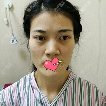 面部自体脂肪填充真是个好办法,看我在郑州张朝蕾做的效果对比
