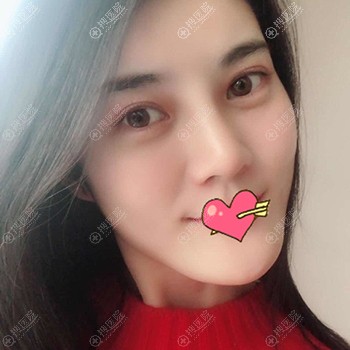 ����֬���沿���15��Ч��