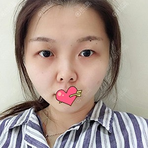 鼻子超难看,找武汉美都做鼻综合手术后感觉一切努力都是值得的