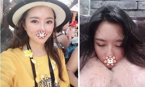 美杜莎双眼皮术后42天睁眼有神闭眼无痕 美杜莎双眼皮术后42天睁眼有神闭眼无痕