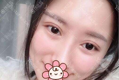 重庆艺星整形美容医院双眼皮术后5天 重庆艺星整形美容医院双眼皮术后5天