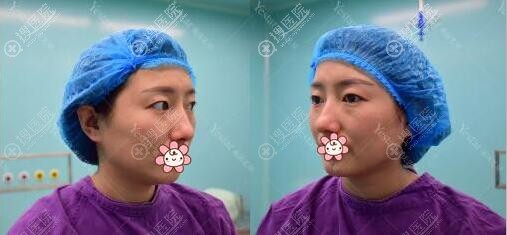 医师根据我的眼部条件建议我做美杜莎双眼皮 医师根据我的眼部条件建议我做美杜莎双眼皮