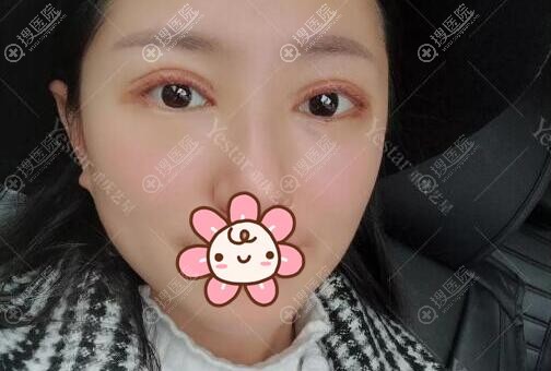美杜莎双眼皮术后3天效果 美杜莎双眼皮术后3天效果