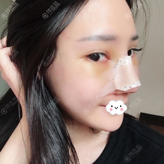 <!--<i data=20240710 data-id=12048></i>-->彭丽霞鼻综合术后效果 <!--<i data=20240710 data-id=12048></i>-->彭丽霞鼻综合术后效果