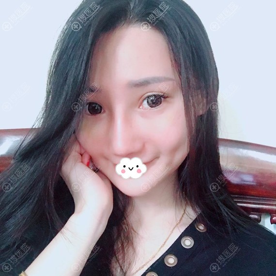 <!--<i data=20240710 data-id=12048></i>-->彭丽霞假体隆鼻案例恢复效果 <!--<i data=20240710 data-id=12048></i>-->彭丽霞假体隆鼻案例恢复效果