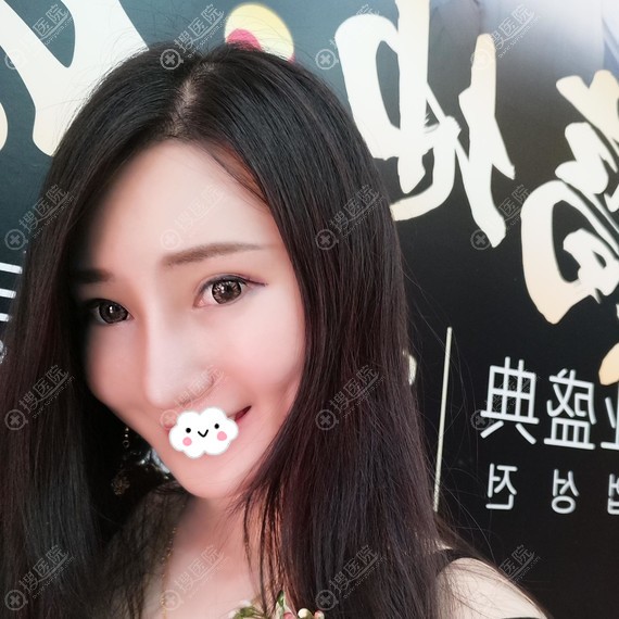 <!--<i data=20240710 data-id=12048></i>-->隆鼻怎么样?彭丽霞假体隆鼻案例 <!--<i data=20240710 data-id=12048></i>-->隆鼻怎么样?彭丽霞假体隆鼻案例