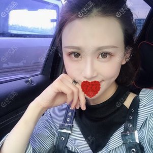 全切双眼皮两个月案例 全切双眼皮两个月案例