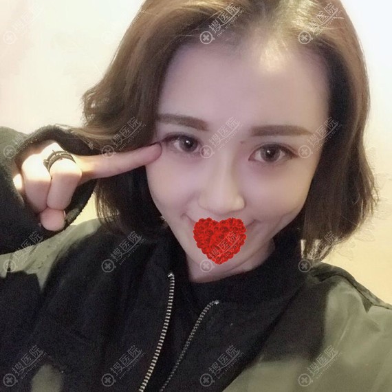 重庆艺星恢复三个月的双眼皮 重庆艺星恢复三个月的双眼皮