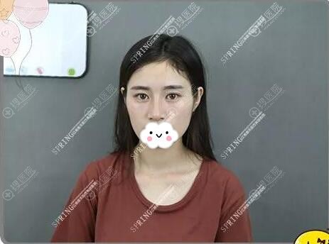 不满以前的隆鼻效果找深圳江南春天蓝剑雄做了肋软骨鼻修复手术