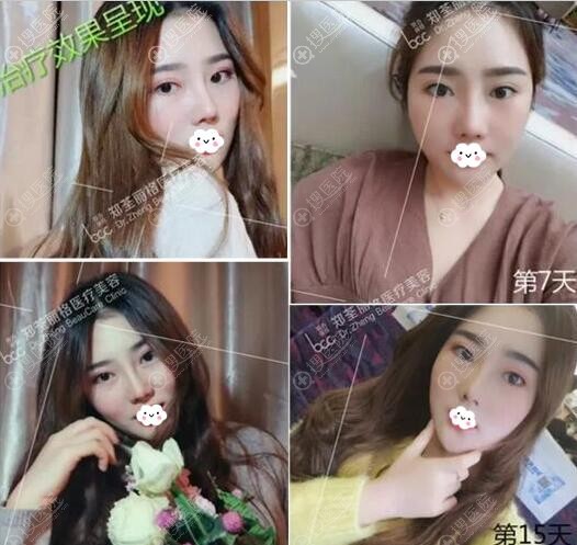重庆郑荃丽格脂肪填充失败修复术后一个月恢复情况 重庆郑荃丽格脂肪填充失败修复术后一个月恢复情况