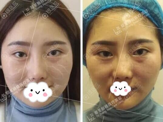 毛钰婷自体脂肪填充失败修复前后对比 毛钰婷自体脂肪填充失败修复前后对比