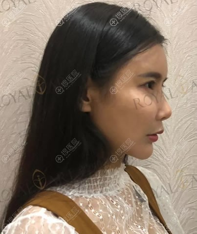 这次找成都蓉雅叶飞轮做隆鼻很成功,于是决定公开我的蜕变日记