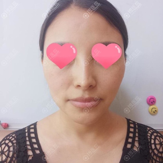 太原欧美莲整形美容医院李永生活细胞自体脂肪面部填充案例价格
