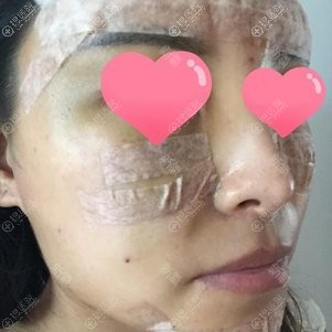 太原欧美莲自体脂肪面部填充术后效果 太原欧美莲自体脂肪面部填充术后效果