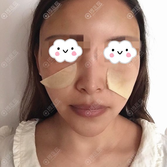 太原欧美莲自体脂肪填充面部术后9天效果图 太原欧美莲自体脂肪填充面部术后9天效果图