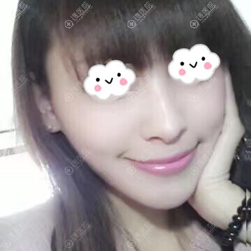 太原自体脂肪填充哪家医院好?太原欧美莲案例 太原自体脂肪填充哪家医院好?太原欧美莲案例