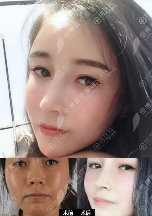 了解半肋和全肋软骨鼻综合的区别后在成都恒博做了半肋隆鼻手术