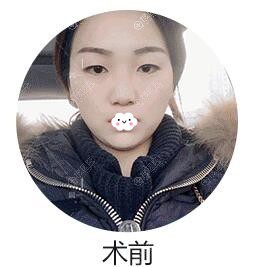 宝鸡高一生医疗美容门诊部双眼皮真人案例 宝鸡高一生医疗美容门诊部双眼皮真人案例
