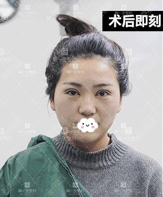 宝鸡高一生双眼皮术后即刻效果 宝鸡高一生双眼皮术后即刻效果