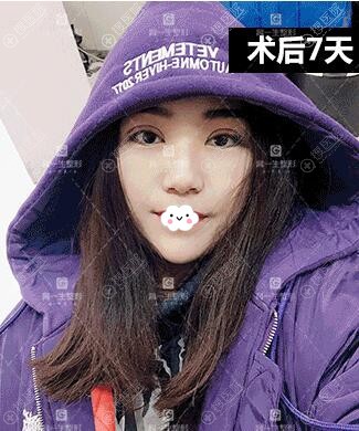 宝鸡高一生割双眼皮怎么样?案例术后7天图片 宝鸡高一生割双眼皮怎么样?案例术后7天图片