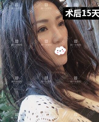 宝鸡割双眼皮哪家医院好?高一生案例 宝鸡割双眼皮哪家医院好?高一生案例