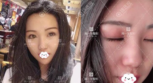 宝鸡高一生双眼皮术后恢复图疤痕效果 宝鸡高一生双眼皮术后恢复图疤痕效果