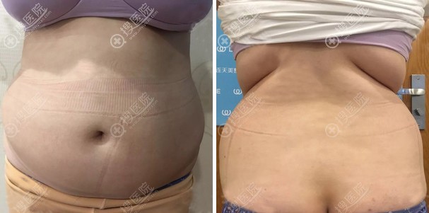 身材像大妈,找义乌连天美张健做了腰腹吸脂后终于可以穿裙子