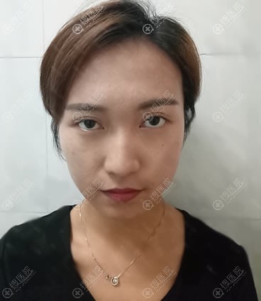 北京韩啸白永辉专注眼修复18年,找他做双眼皮失败修复成功归来