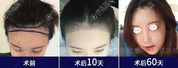 广州荔医发际线种植真人案例 广州荔医发际线种植真人案例