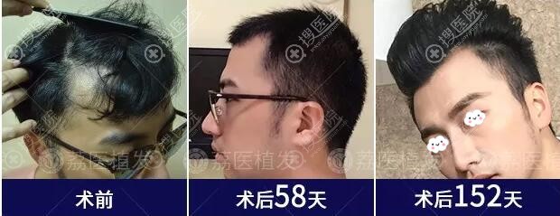 广州荔医头顶加密+额角种植真人案例 广州荔医头顶加密+额角种植真人案例