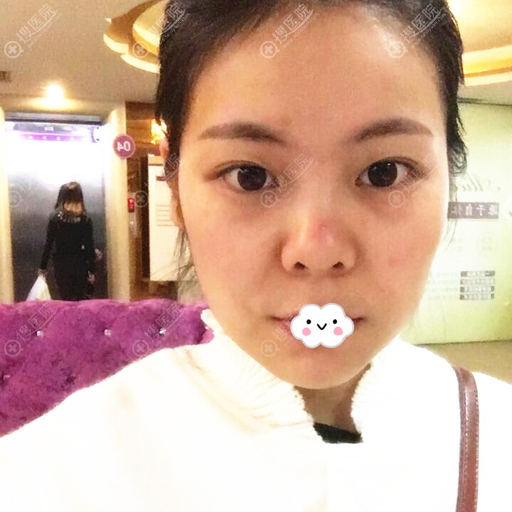 打玻尿酸鼻变宽看广州美恩沈绍勇假体隆鼻+耳软骨垫鼻尖咋样?