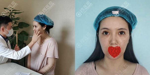 我在苏州瑞芙臣找徐增亮通过埋线提升,连皮肤也变得越来越好