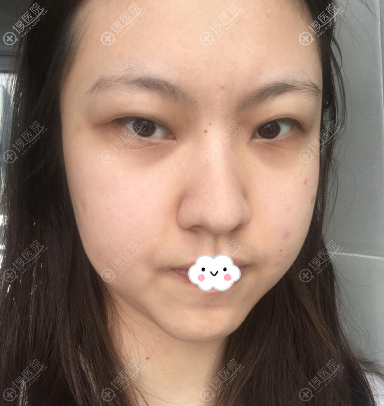 <!--<i data=20240710 data-id=11950></i>-->姜友定眼综合真人案例 <!--<i data=20240710 data-id=11950></i>-->姜友定眼综合真人案例