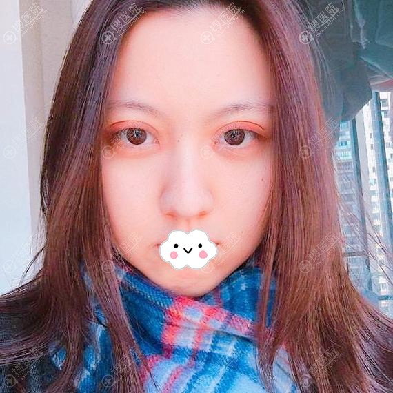 <!--<i data=20240710 data-id=11950></i>-->割双眼皮效果怎么样?姜友定眼综合案例 <!--<i data=20240710 data-id=11950></i>-->割双眼皮效果怎么样?姜友定眼综合案例