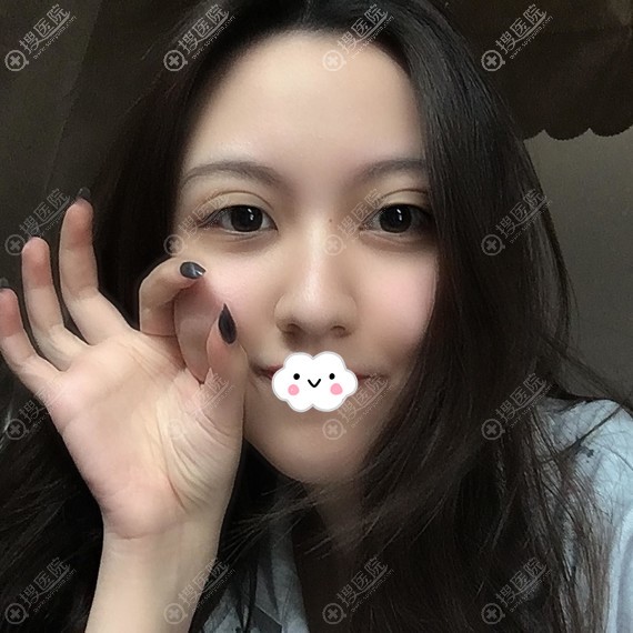 <!--<i data=20240710 data-id=11950></i>-->姜友定切开双眼皮案例术后效果 <!--<i data=20240710 data-id=11950></i>-->姜友定切开双眼皮案例术后效果