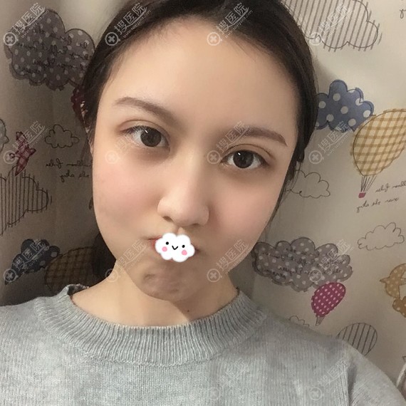 广州割双眼皮哪家医院好?<!--<i data=20240710 data-id=11950></i>-->眼综合真人案例 广州割双眼皮哪家医院好?<!--<i data=20240710 data-id=11950></i>-->眼综合真人案例