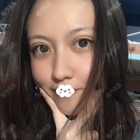 <!--<i data=20240710 data-id=11950></i>-->双眼皮术后恢复照片 <!--<i data=20240710 data-id=11950></i>-->双眼皮术后恢复照片