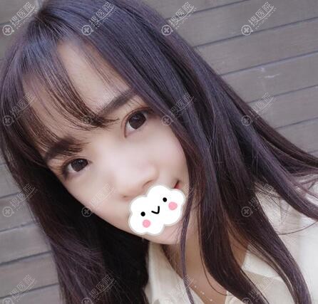 嫉妒做整形变漂亮的朋友,我去深圳恩吉娜找张锋做了鼻综合手术