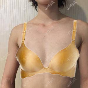想搏C位看杭州连天美程琳做的假体隆胸案例恢复效果怎么样