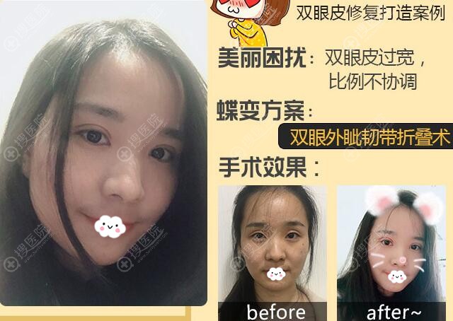 广州可玫尔<!--<i data=20240710 data-id=17507></i>-->诚眼部修复案例效果对比 广州可玫尔<!--<i data=20240710 data-id=17507></i>-->诚眼部修复案例效果对比