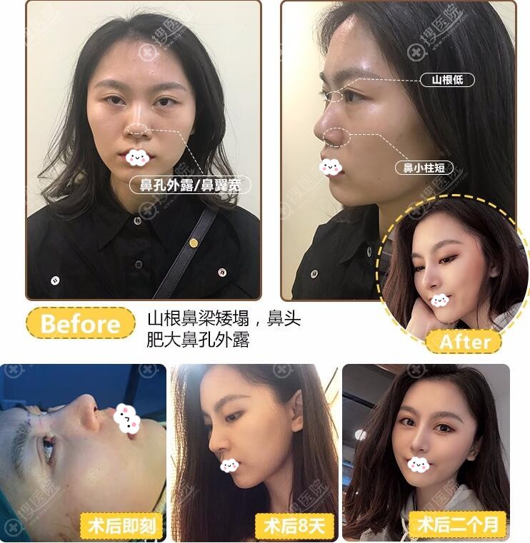 广州可玫尔张球俊院长鼻综合案例恢复图 广州可玫尔张球俊院长鼻综合案例恢复图