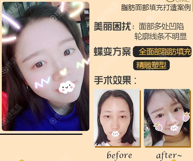 广州可玫尔自体脂肪填充全脸案例对比图 广州可玫尔自体脂肪填充全脸案例对比图