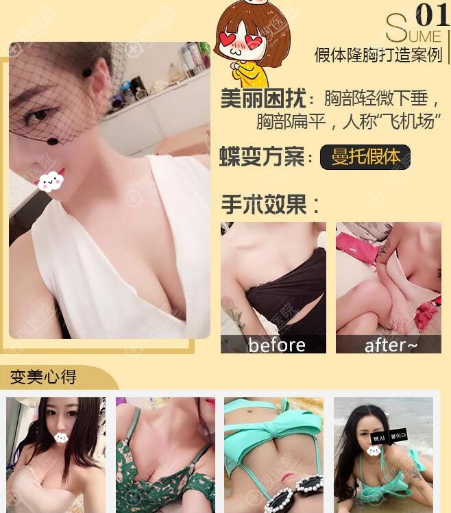 广州可玫尔张球俊假体隆胸案例 广州可玫尔张球俊假体隆胸案例