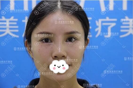 爆料闺蜜在深圳美加美找周国伟做肋软骨隆鼻修复手术的整形史