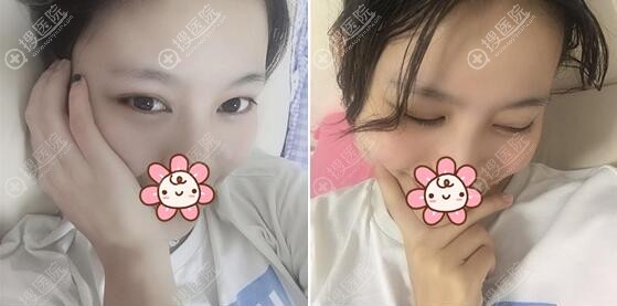胡珍珍埋线双眼皮术后2个月闭眼无痕 胡珍珍埋线双眼皮术后2个月闭眼无痕