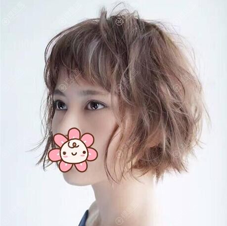 深圳瑞尼丝胡珍珍埋线双眼皮术后美照 深圳瑞尼丝胡珍珍埋线双眼皮术后美照
